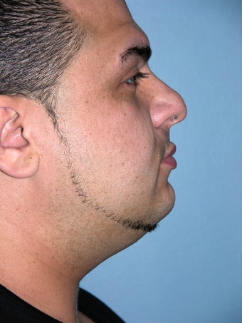 Male Rhinoplasty before 1374785