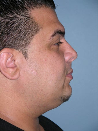 Male Rhinoplasty after 1374785