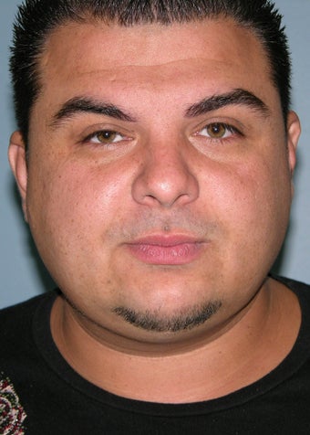 Male Rhinoplasty 1374785