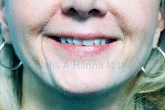 Restylane Injections 1394193