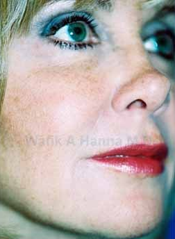 Restylane Injections after 1394193