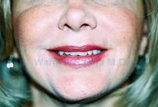 Restylane Injections 1394193