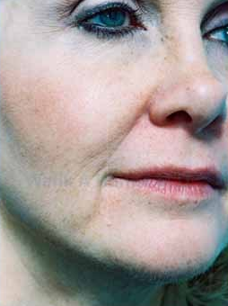 Restylane Injections before 1394193