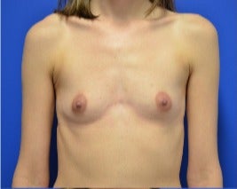 25-34 year old woman treated with Breast Augmentation before 3339132