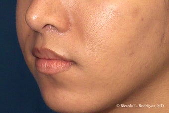 Lip Lift after 635448