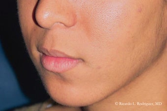 Lip Lift before 635448