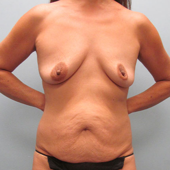 50 year old woman treated with Mommy Makeover before 3680042