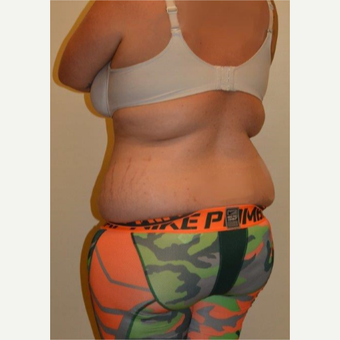 25-34 year old woman treated with Liposuction before 3658468