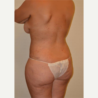 25-34 year old woman treated with Liposuction after 3658468