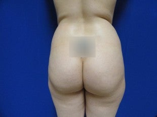 24 year old Fat grafting to butt and hips before 657678