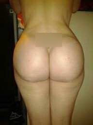 24 year old Fat grafting to butt and hips after 657678