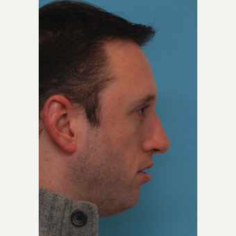 25-34 year old man treated with Orthognathic Surgery before 3537599
