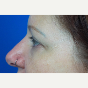35-44 year old woman treated with Eyelid Surgery before 3376381