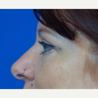 35-44 year old woman treated with Eyelid Surgery after 3376381