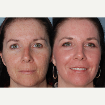 35-44 year old woman treated with Acne Scars Treatment before 3415182
