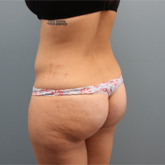 Liposuction of the abdomen, hips, lateral thighs and low back before 3467369