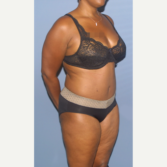 35-44 year old woman treated with Tummy Tuck after 3581260