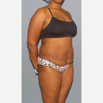 35-44 year old woman treated with Tummy Tuck before 3581260