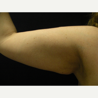35-44 year old woman treated with CoolSculpting before 3680945