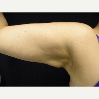 35-44 year old woman treated with CoolSculpting after 3680945
