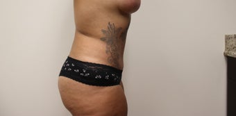 Tummy Tuck after 3417692