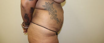 Tummy Tuck before 3417692