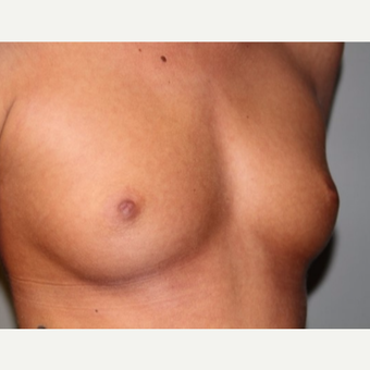 25-34 year old woman treated with Breast Implants before 2878005