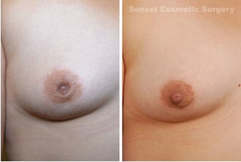 Inverted Nipple Repair before 902702