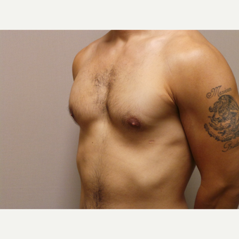 25-34 year old man treated with Male Breast Reduction after 3454719