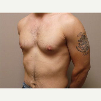 25-34 year old man treated with Male Breast Reduction before 3454719