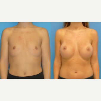 35-44 year old woman treated with Breast Augmentation before 2766138