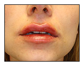 Injectables after 722760