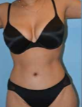 45-54 year old woman treated with Tummy Tuck after 2327025
