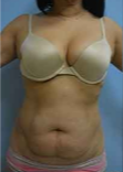 45-54 year old woman treated with Tummy Tuck before 2327025