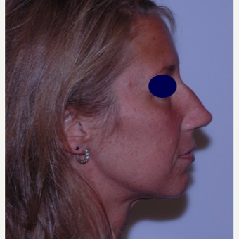 Rhinoplasty before 3324542