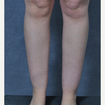 25-34 year old woman treated with Liposuction to the ankles before 3816087