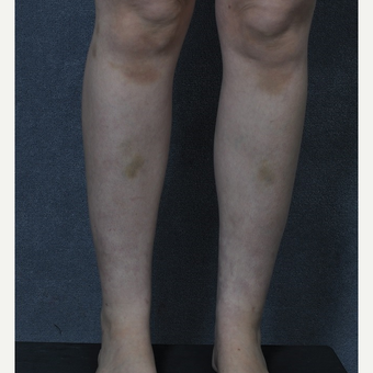 25-34 year old woman treated with Liposuction to the ankles after 3816087