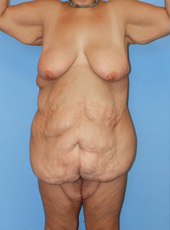 High-Definition™ Total Body Lift before 177427