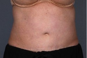 Liposonix after 1077904