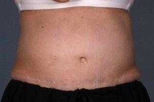 Liposonix before 1077904