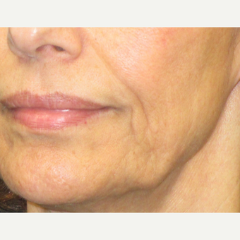 55-64 year old woman treated with Laser Treatment before 3140158