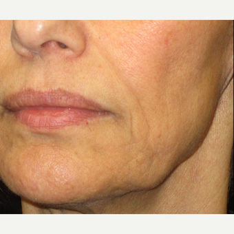 55-64 year old woman treated with Laser Treatment after 3140158