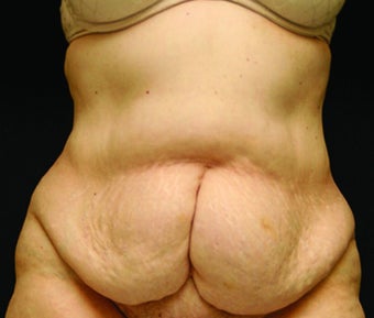 woman in early 60's treated with Tummy Tuck before 1953606