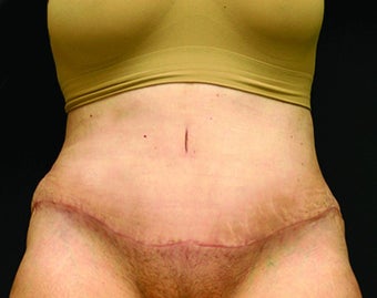 woman in early 60's treated with Tummy Tuck after 1953606