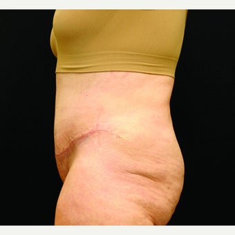 woman in early 60's treated with Tummy Tuck 1953606