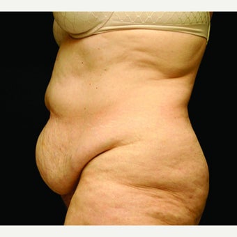 woman in early 60's treated with Tummy Tuck 1953606