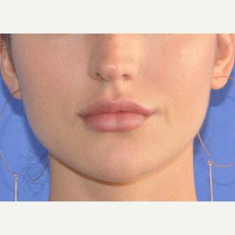 25-34 year old woman treated with Lip Augmentation after 3300122