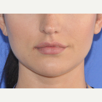25-34 year old woman treated with Lip Augmentation before 3300122