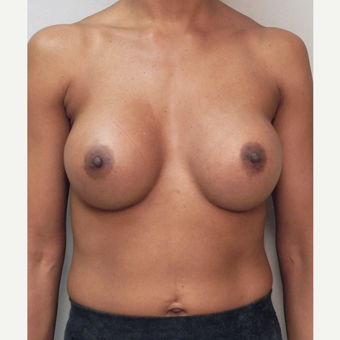 Breast Implants after 3241601