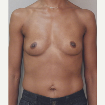 Breast Implants before 3241601